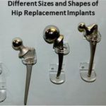 different-sizes-and-shapes-of-hip-replacement-implants-display